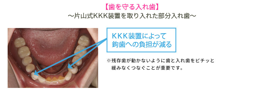 葉を守る入れ歯～片山式KKK装置を取り入れた部分入れ歯～