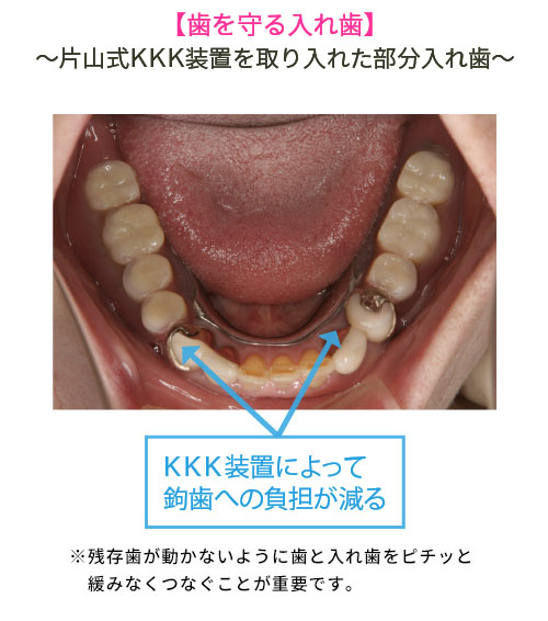 葉を守る入れ歯～片山式KKK装置を取り入れた部分入れ歯～